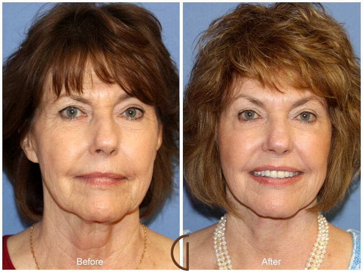 Facelift 60s Before & After Gallery - Patient 573048 - Image 2