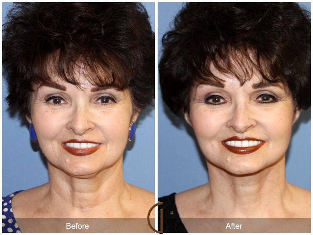 Facelift 60s Before & After Gallery - Patient 379679 - Image 2