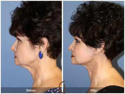 Facelift 60s Before & After Gallery - Patient 379679 - Image 1