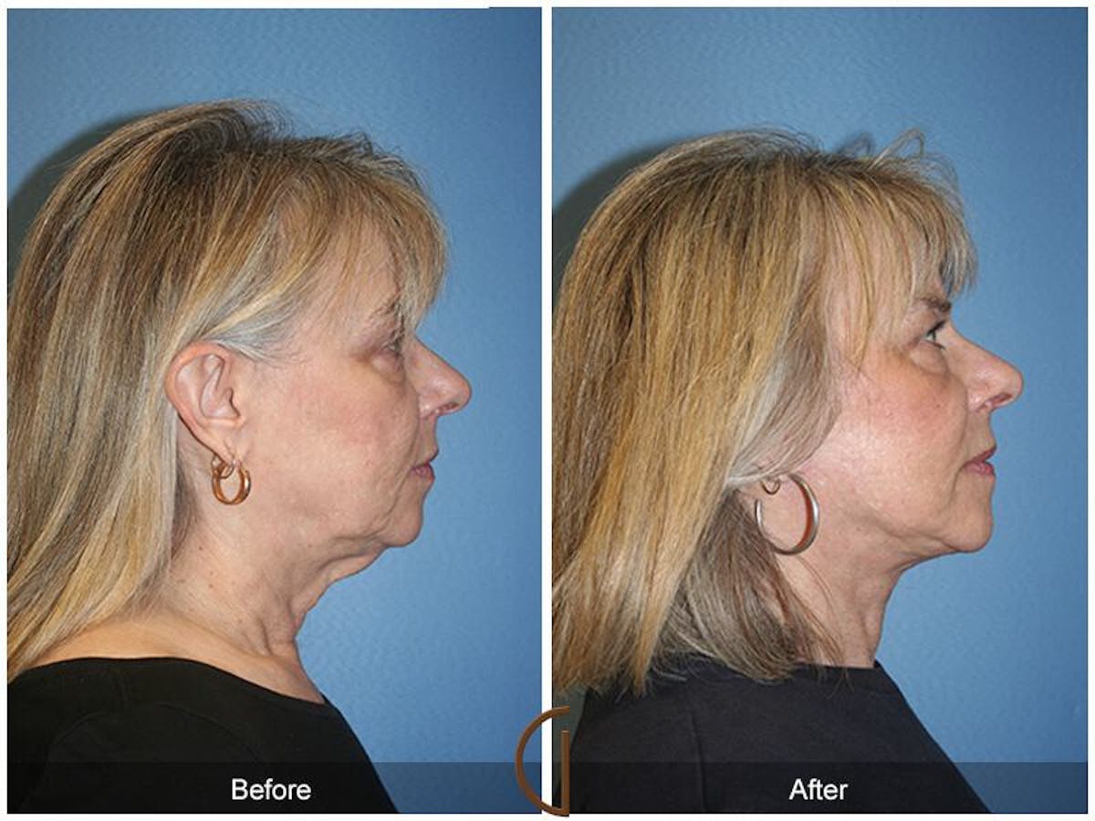 Facelift 60s Before & After Gallery - Patient 844708 - Image 3