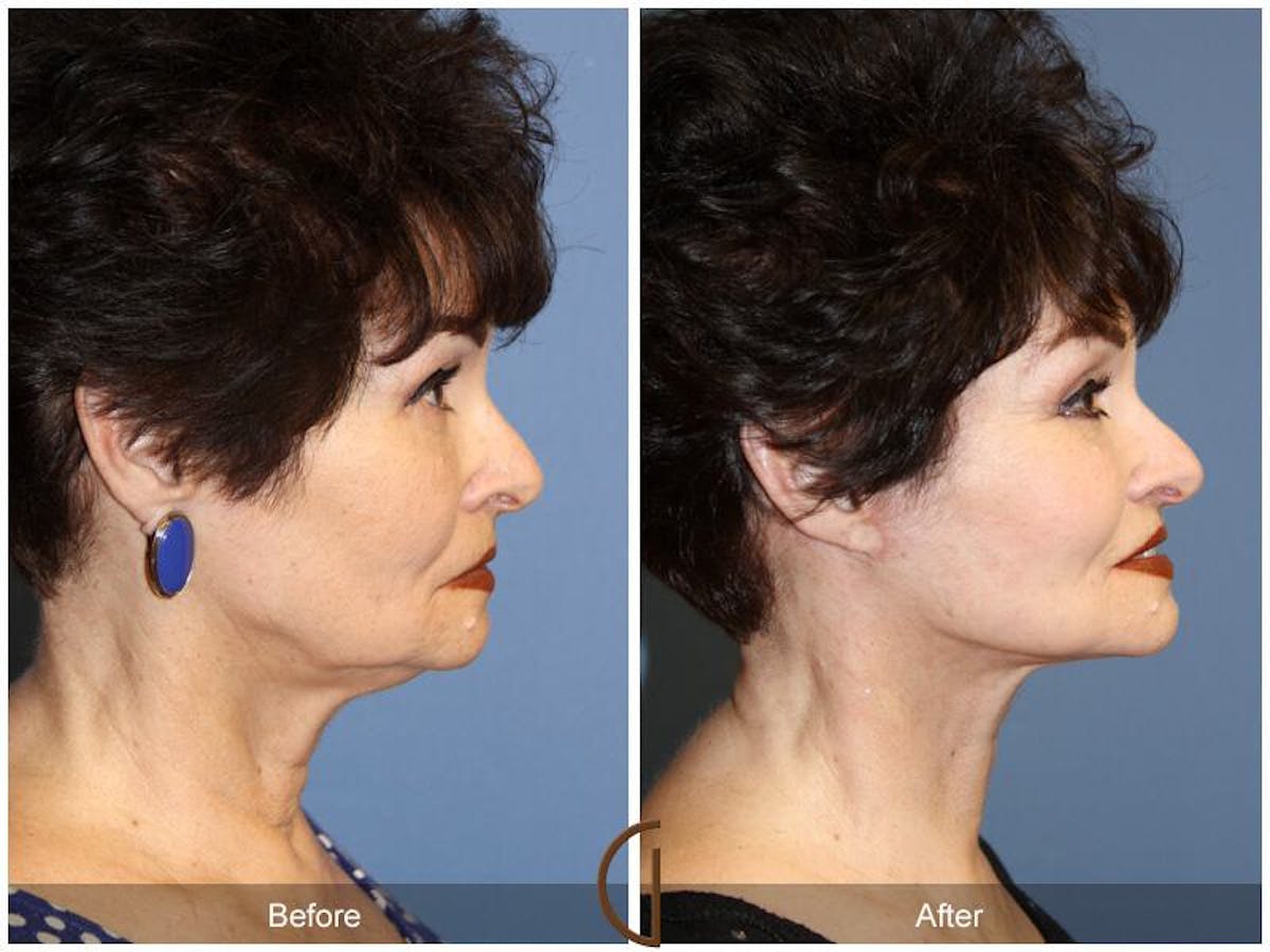 Facelift 60s Before & After Gallery - Patient 379679 - Image 3