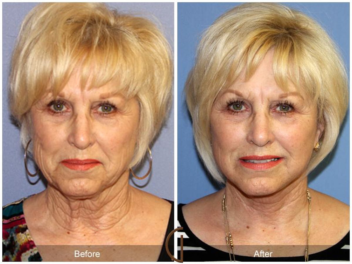Facelift 60s Before & After Gallery - Patient 485487 - Image 2