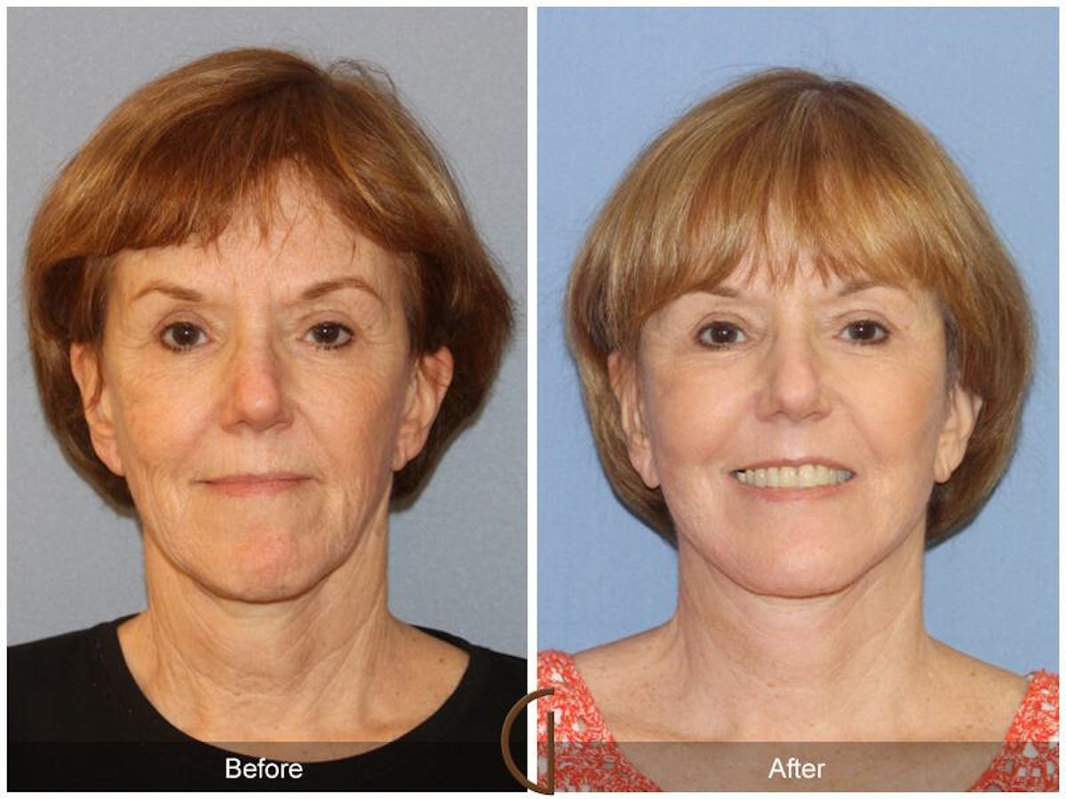 Facelift 60s Before & After Gallery - Patient 188267 - Image 2