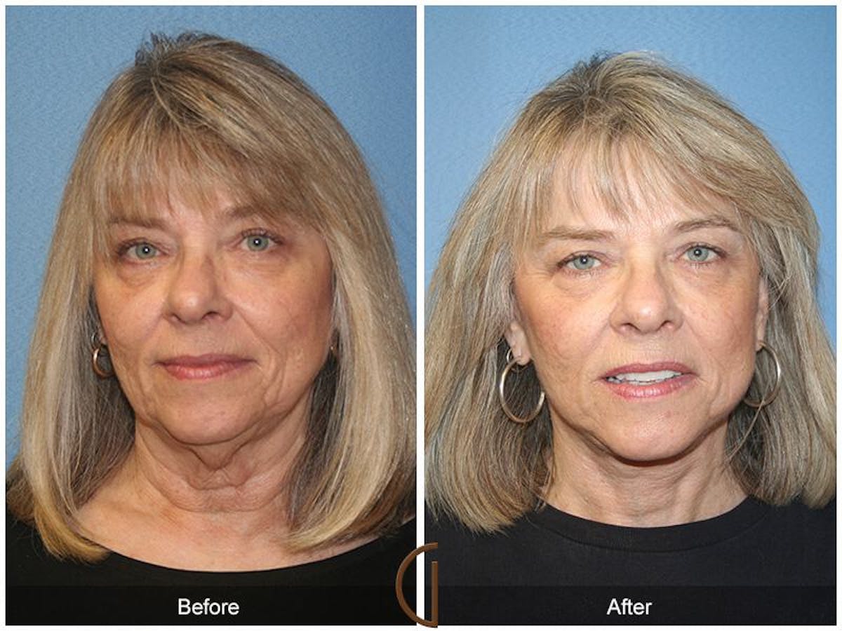 Facelift 60s Before & After Gallery - Patient 844708 - Image 2