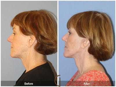 Facelift 60s Before & After Gallery - Patient 188267 - Image 1