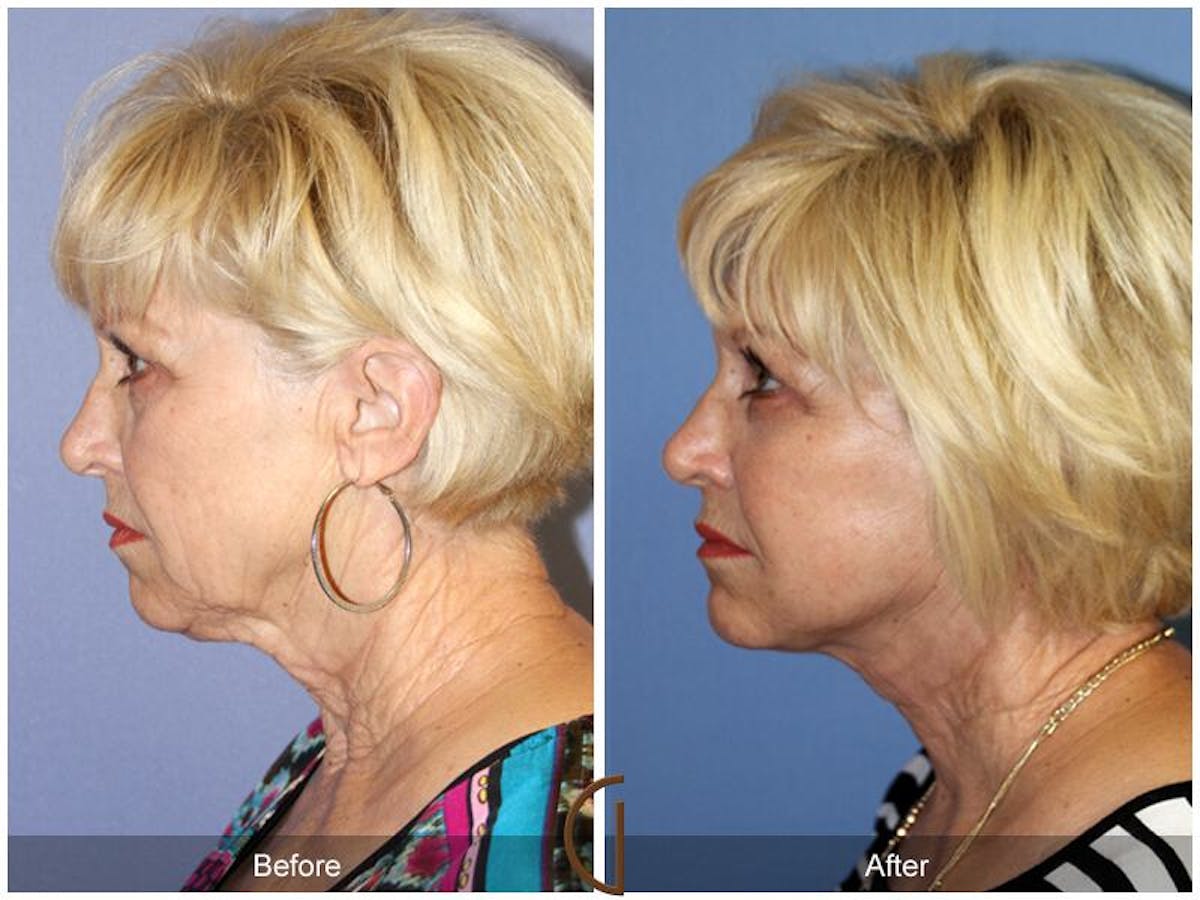 Facelift 60s Before & After Gallery - Patient 485487 - Image 1