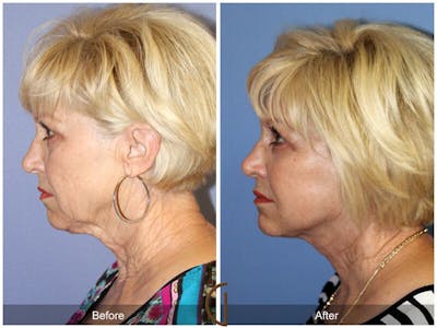Facelift 60s Before & After Gallery - Patient 485487 - Image 1