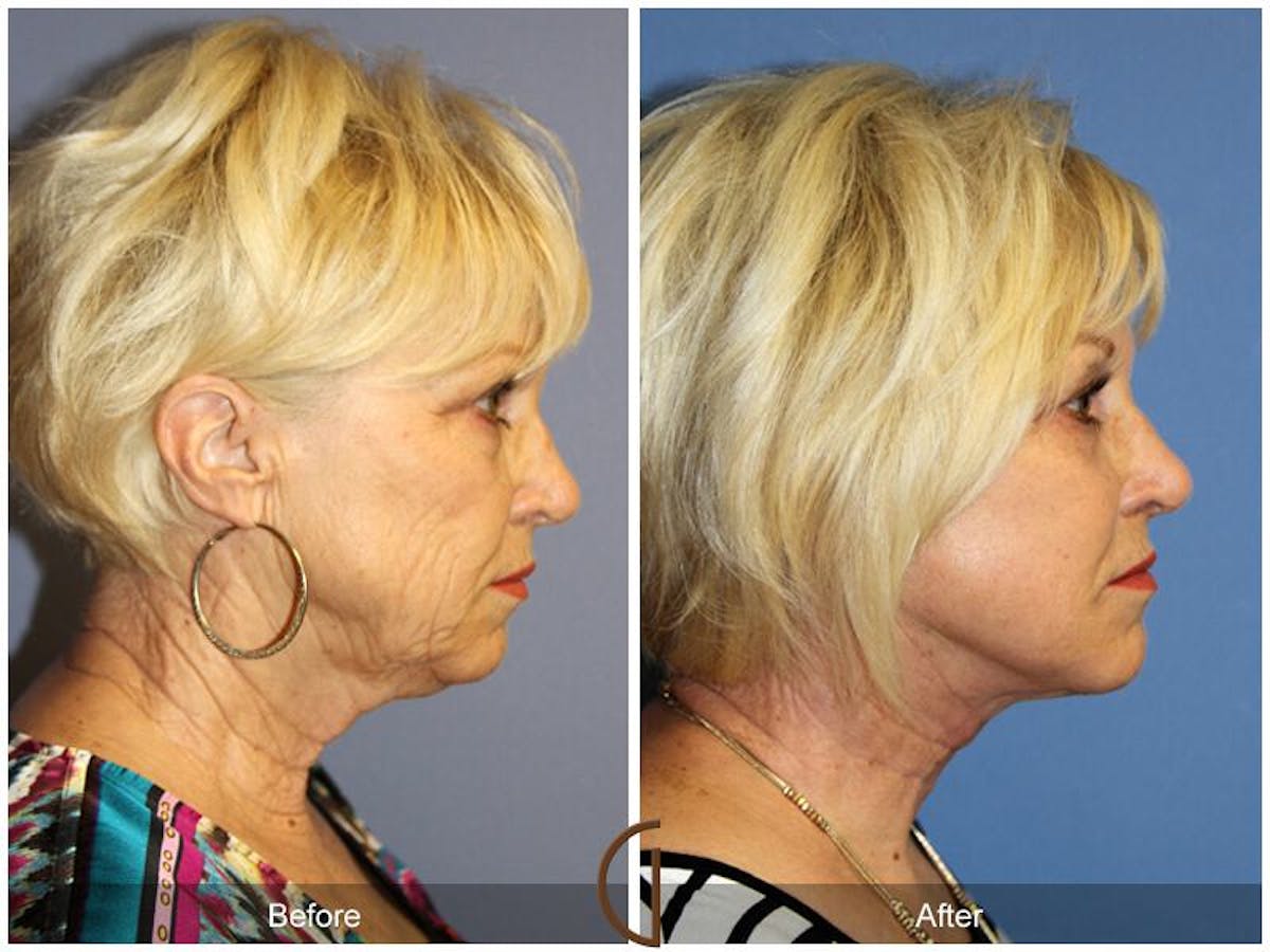 Facelift 60s Before & After Gallery - Patient 485487 - Image 3