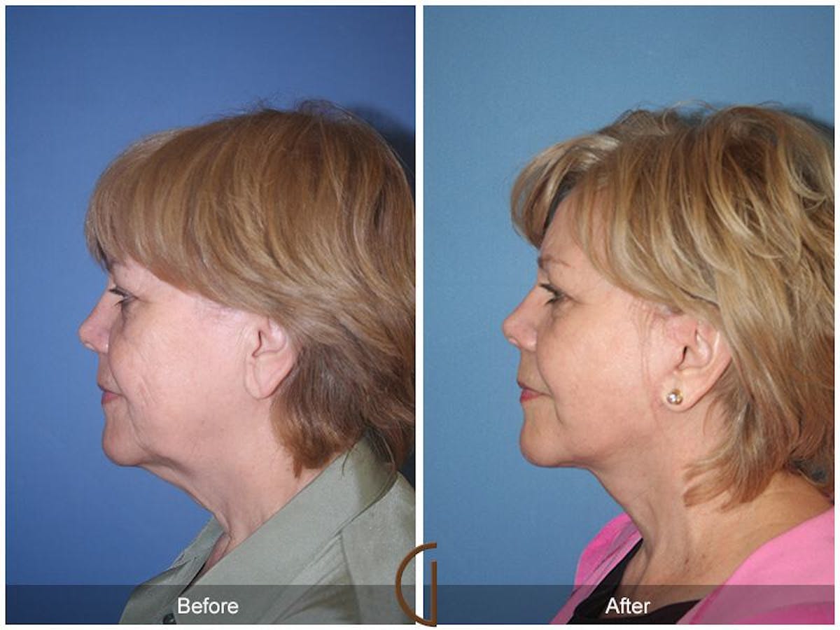 Facelift 60s Before & After Gallery - Patient 871289 - Image 1