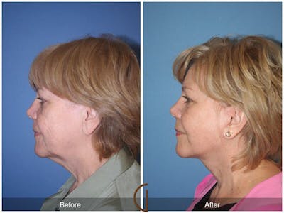 Facelift 60s Before & After Gallery - Patient 871289 - Image 1