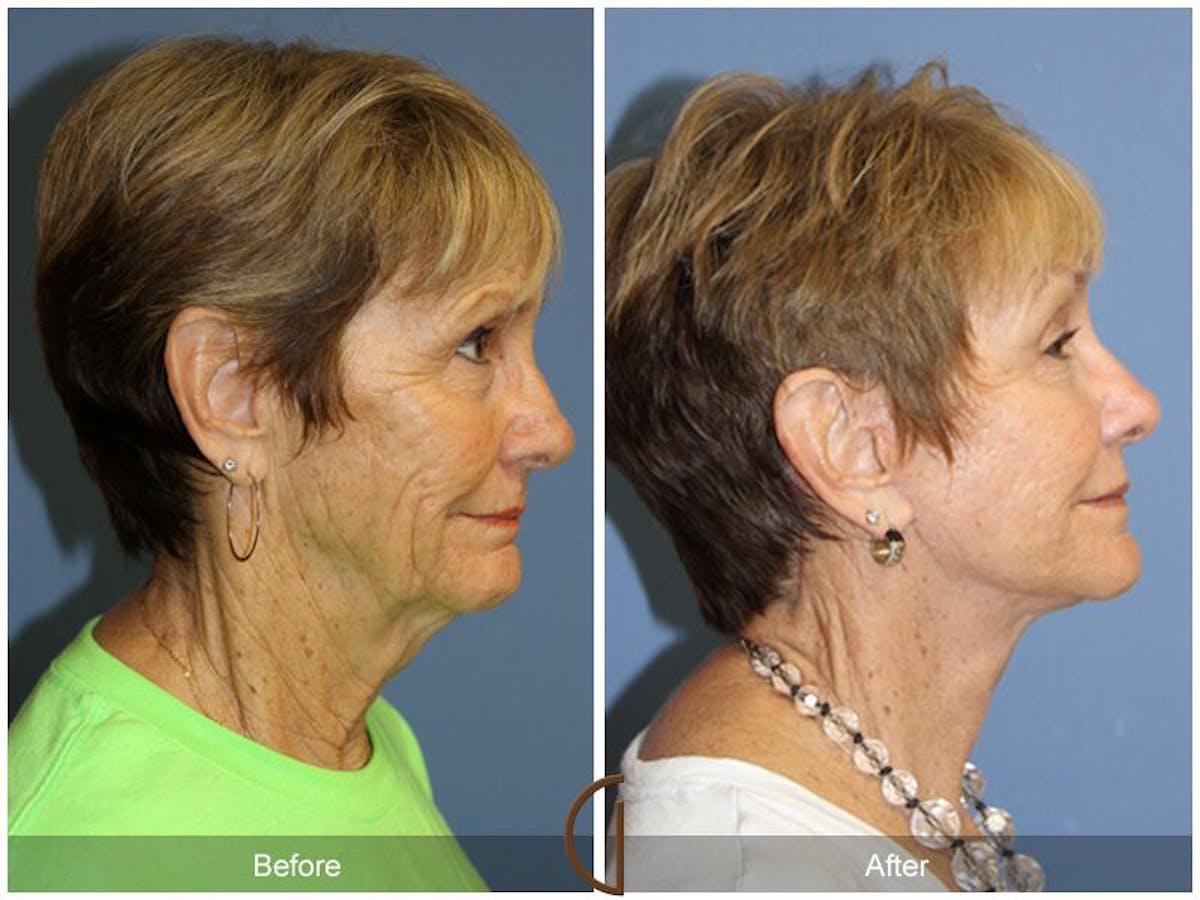 Facelift 60s Before & After Gallery - Patient 166602 - Image 3