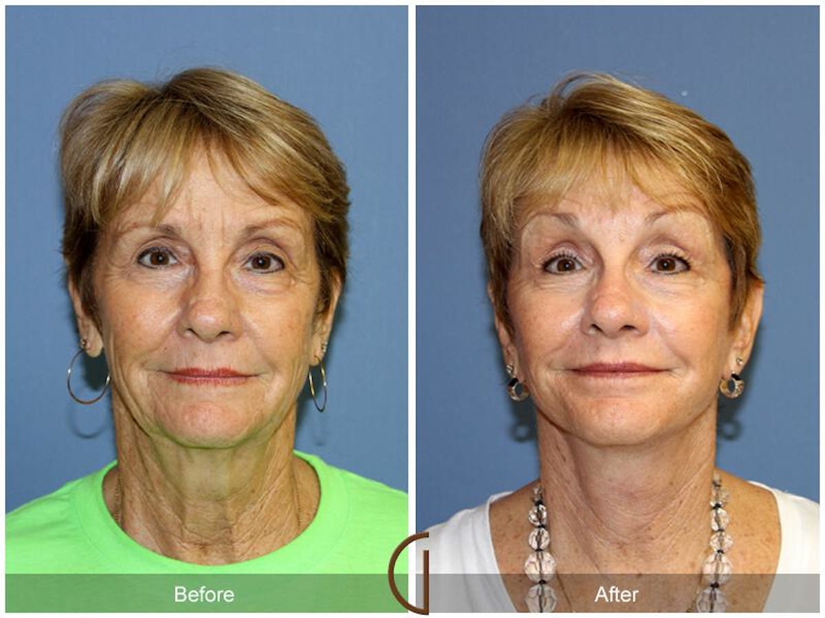 Facelift 60s Before & After Gallery - Patient 166602 - Image 2
