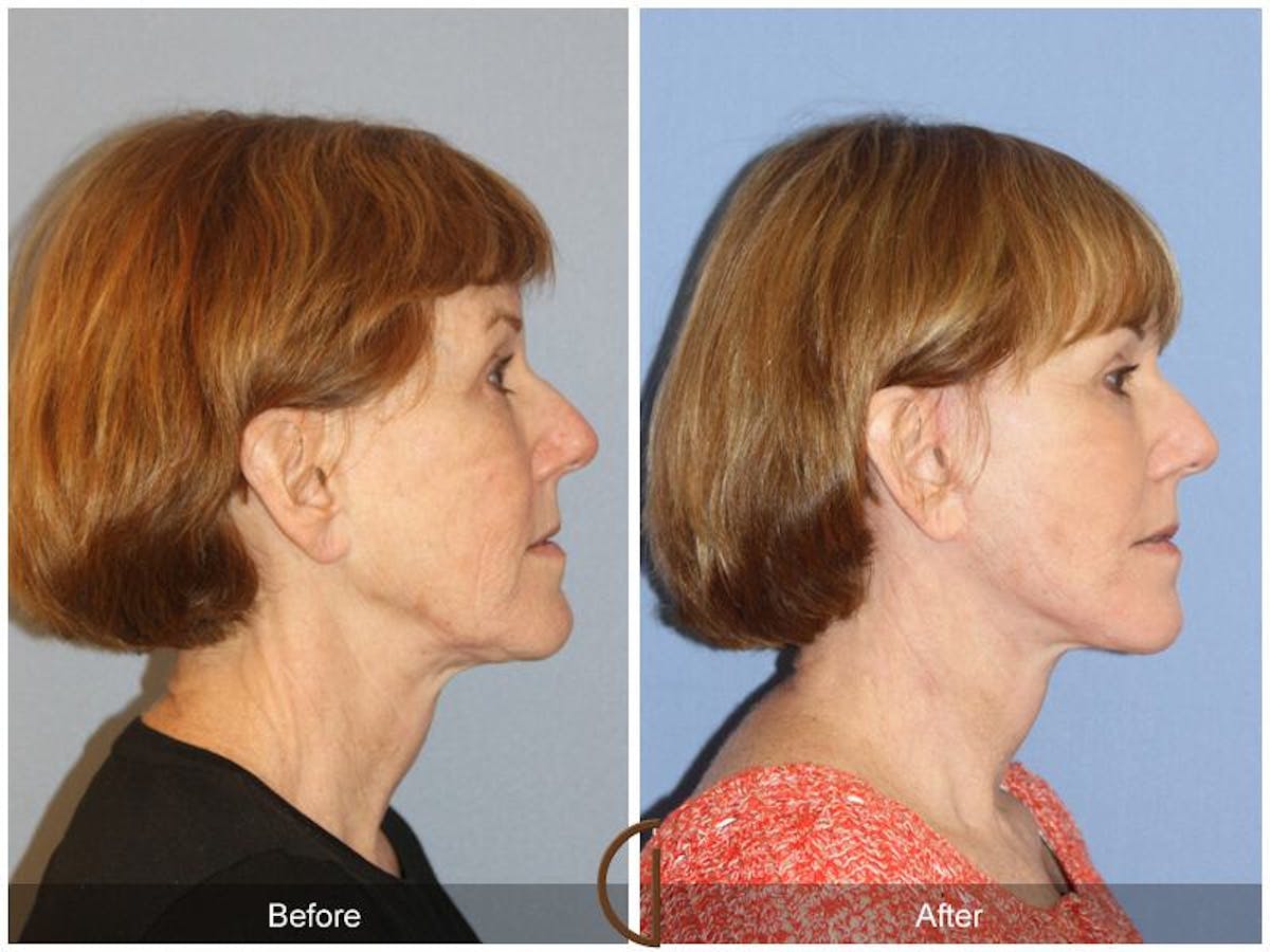 Facelift 60s Before & After Gallery - Patient 188267 - Image 3