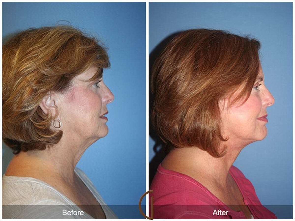 Facelift 60s Before & After Gallery - Patient 202897 - Image 3