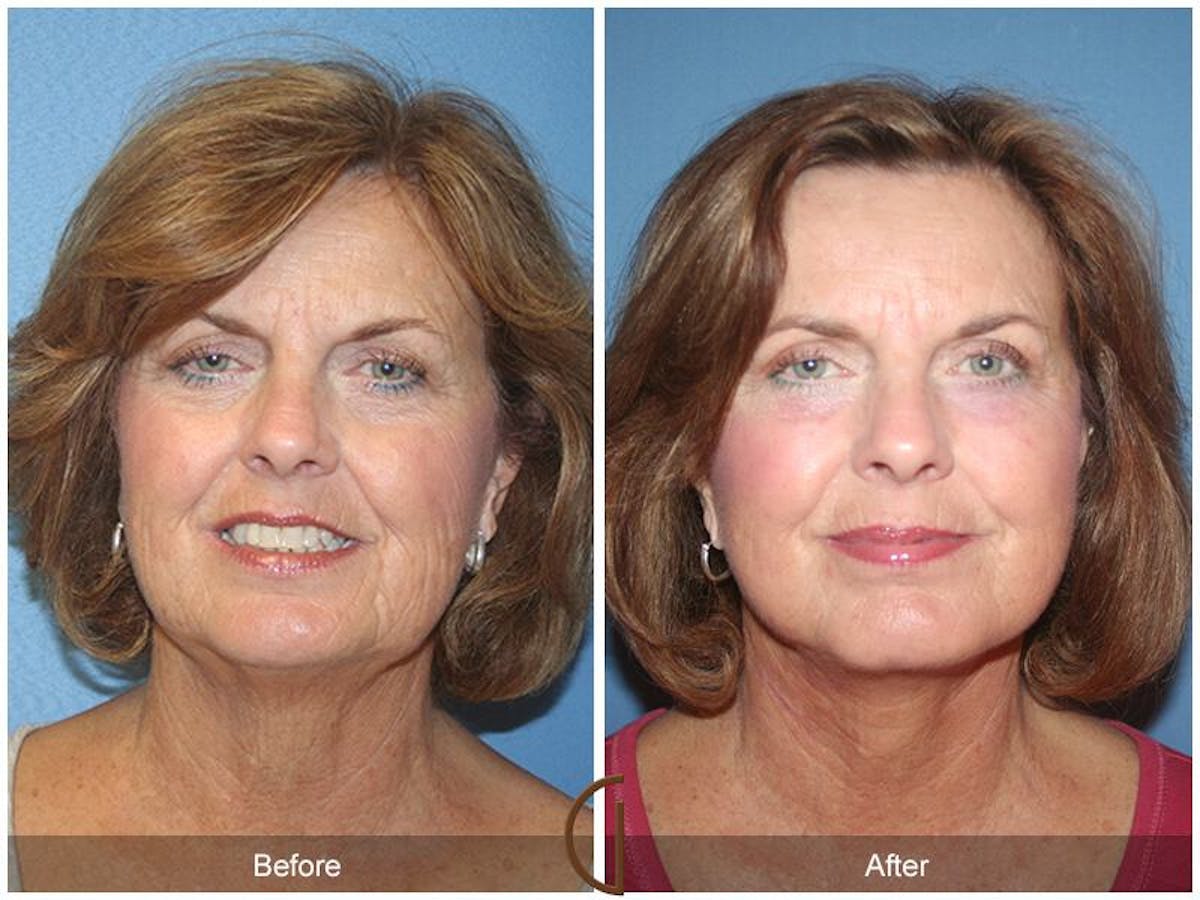 Facelift 60s Before & After Gallery - Patient 202897 - Image 2