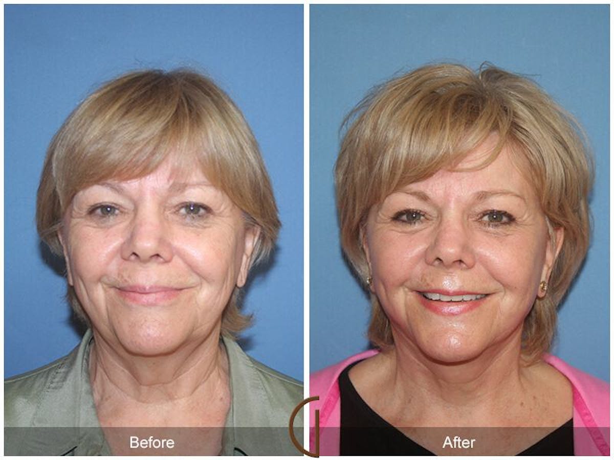 Facelift 60s Before & After Gallery - Patient 871289 - Image 2