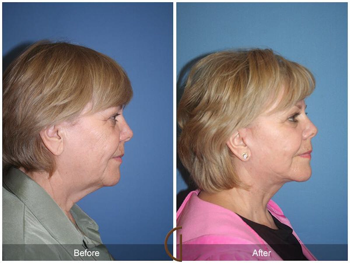 Facelift 60s Before & After Gallery - Patient 871289 - Image 3