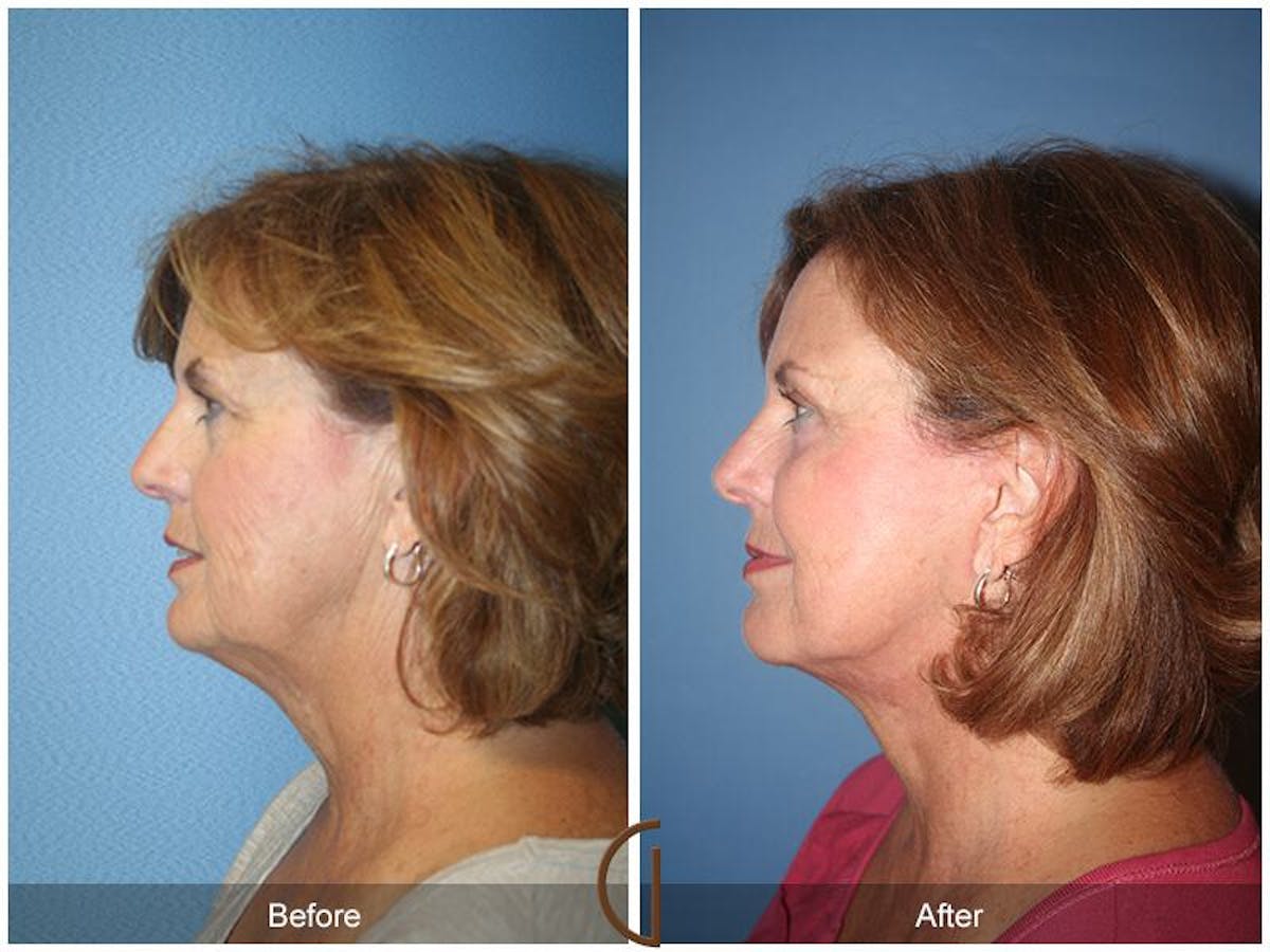 Facelift 60s Before & After Gallery - Patient 202897 - Image 1