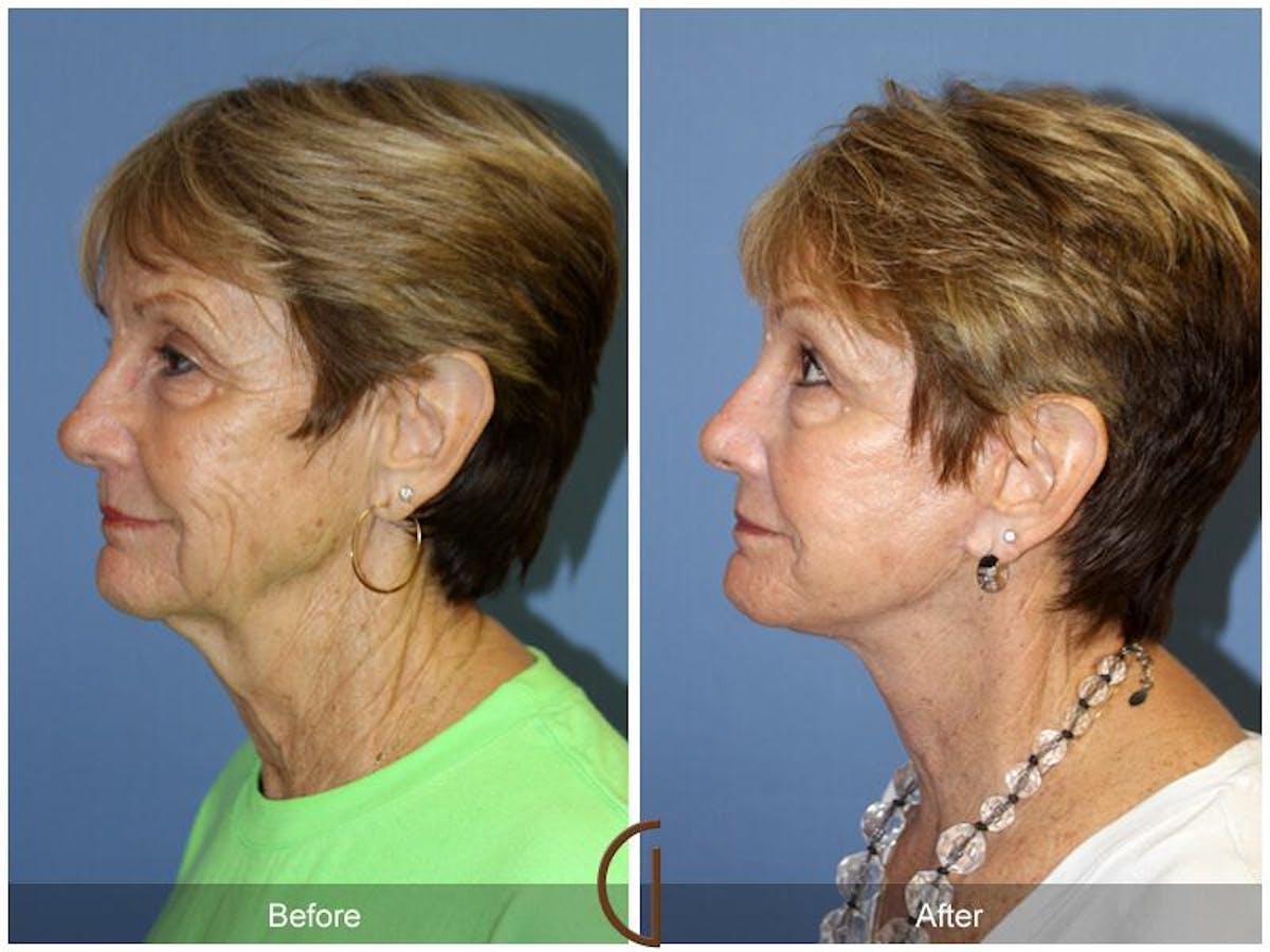Facelift 60s Before & After Gallery - Patient 166602 - Image 1