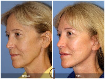 Facelift 60s Before & After Gallery - Patient 250401 - Image 1