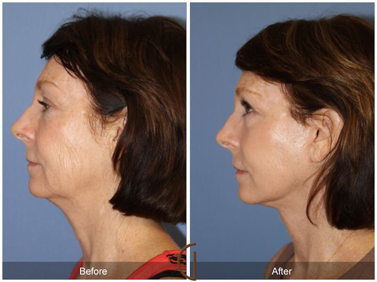 Facelift 60s Before & After Gallery - Patient 200733 - Image 1