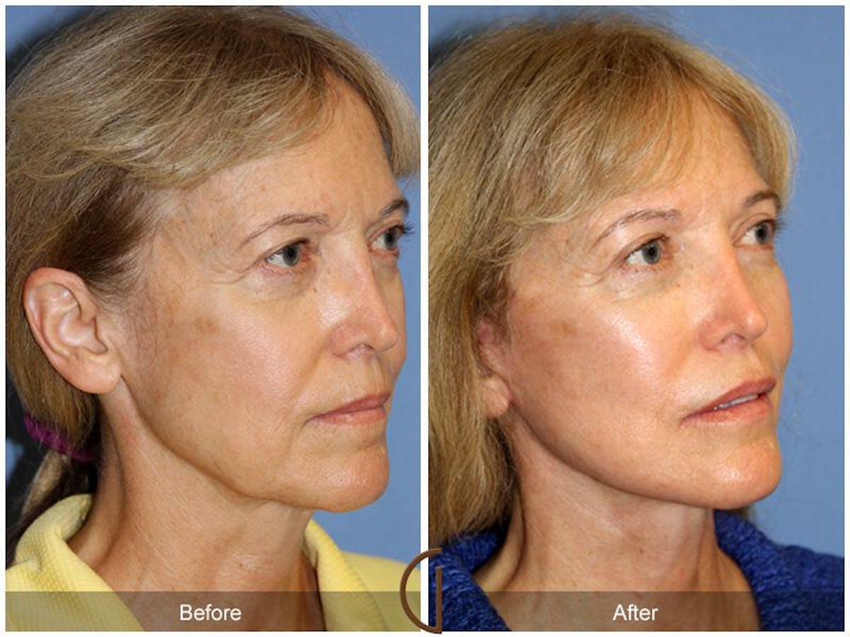 Facelift 60s Before & After Gallery - Patient 250401 - Image 3