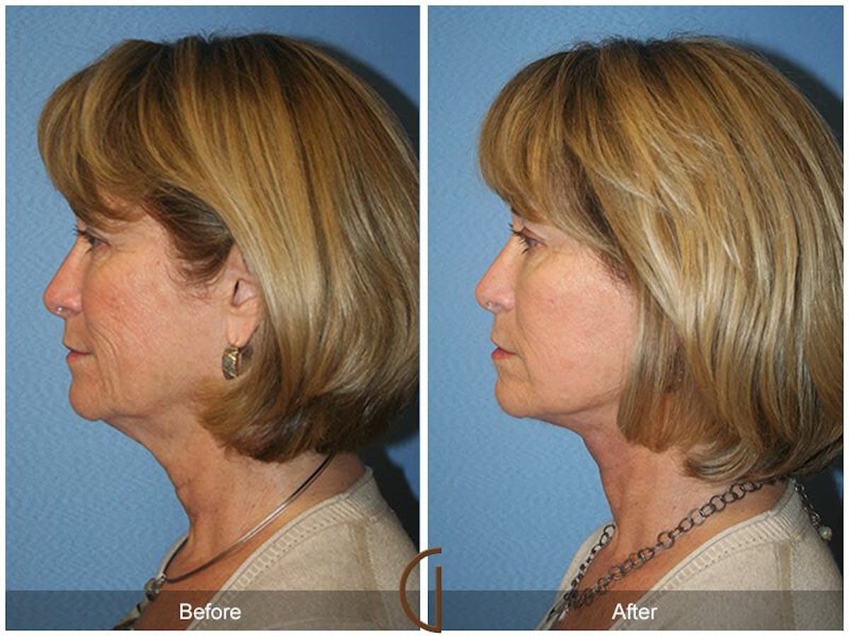 Facelift 60s Before & After Gallery - Patient 104841 - Image 1