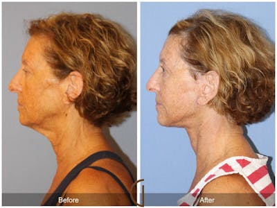 Facelift 60s Before & After Gallery - Patient 243174 - Image 1