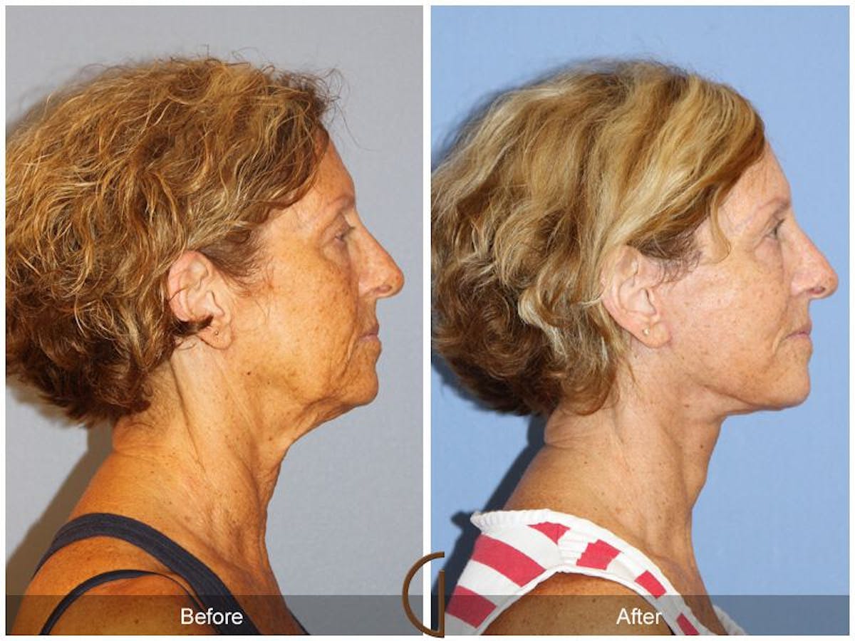 Facelift 60s Before & After Gallery - Patient 243174 - Image 3