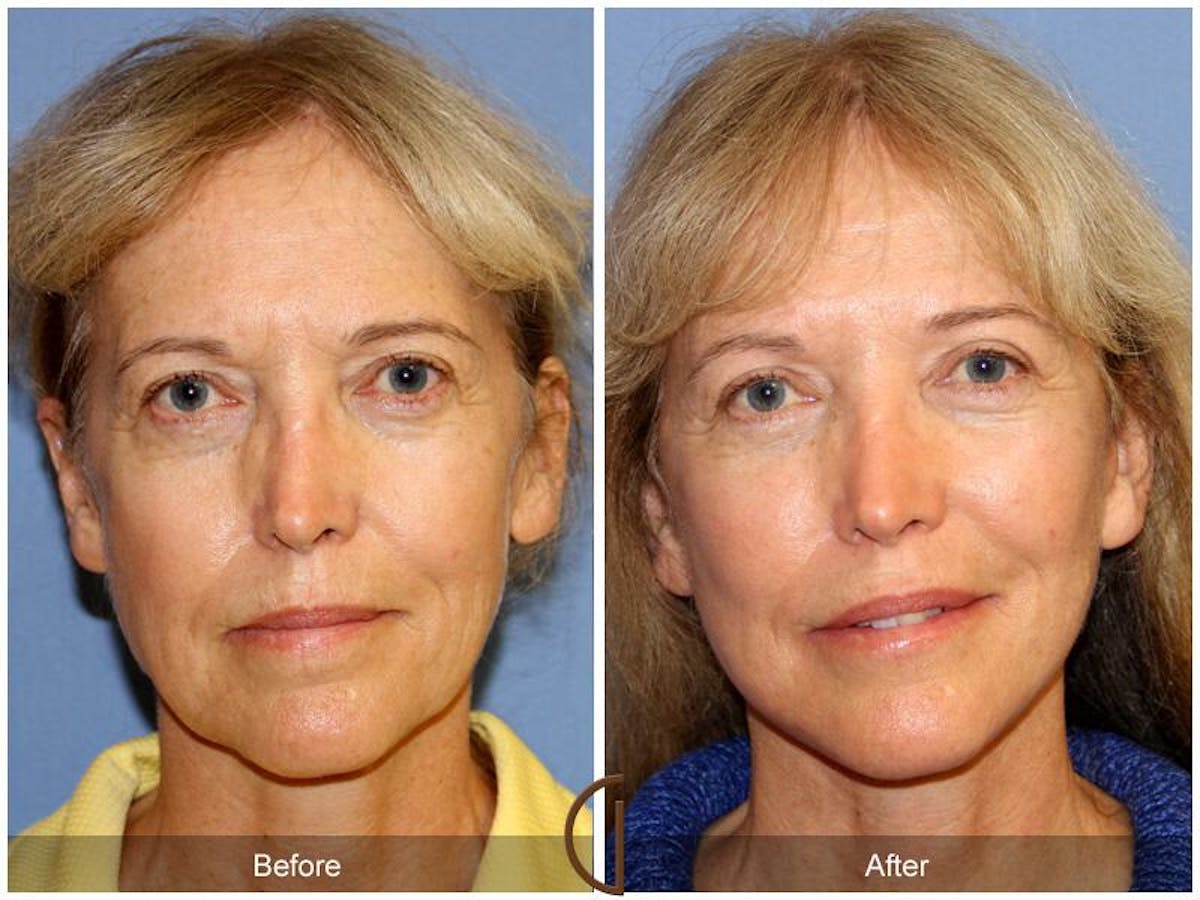 Facelift 60s Before & After Gallery - Patient 250401 - Image 2