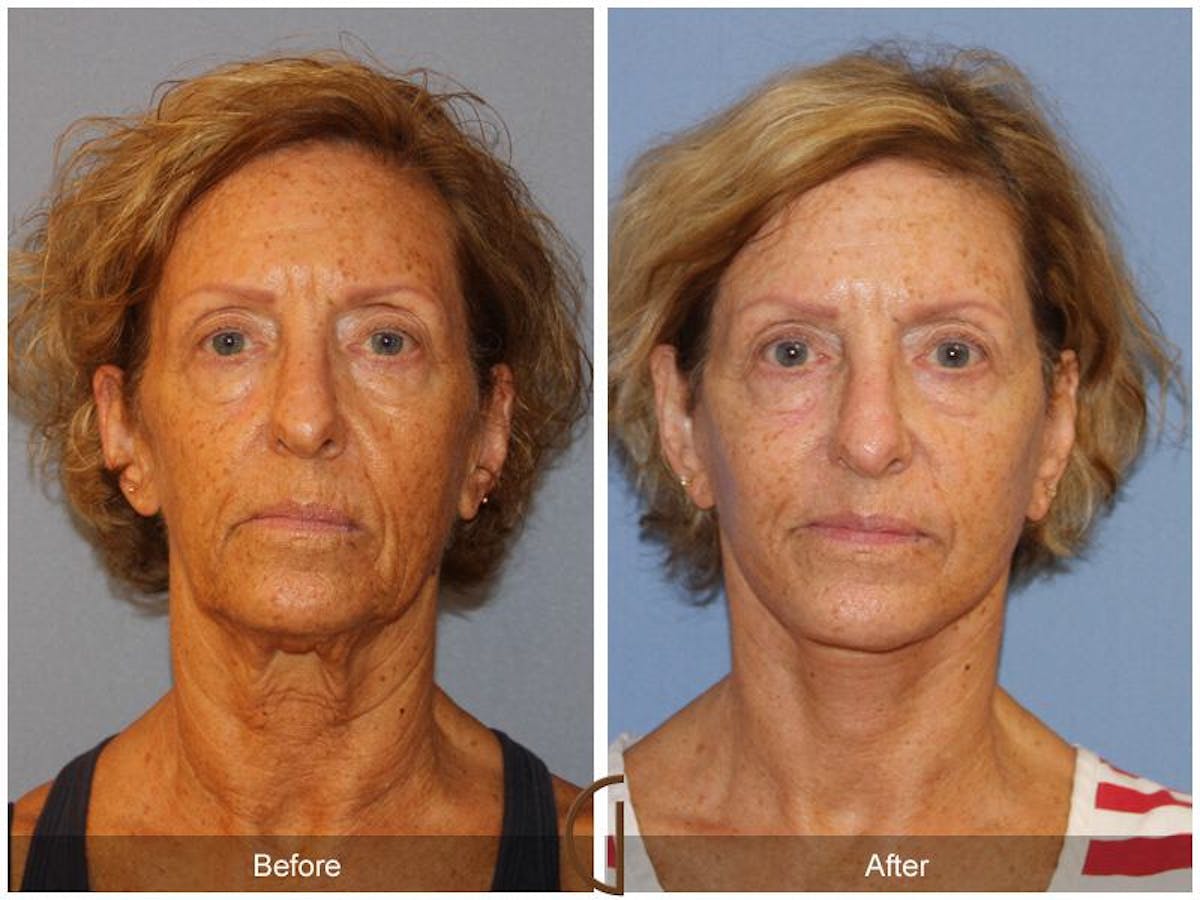 Facelift 60s Before & After Gallery - Patient 243174 - Image 2