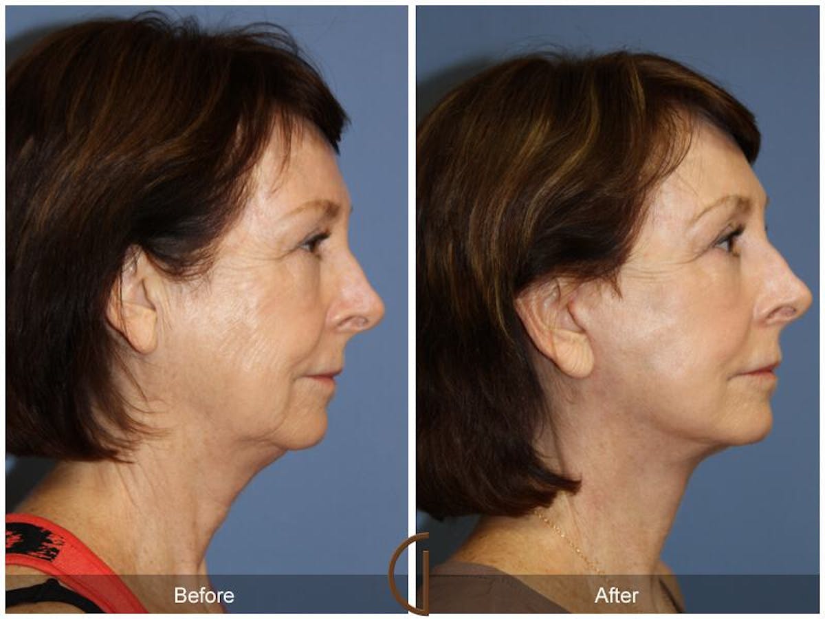 Facelift 60s Before & After Gallery - Patient 200733 - Image 3