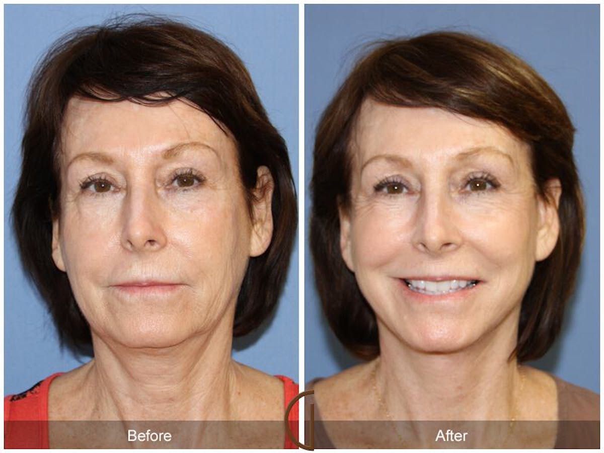 Facelift 60s Before & After Gallery - Patient 200733 - Image 2