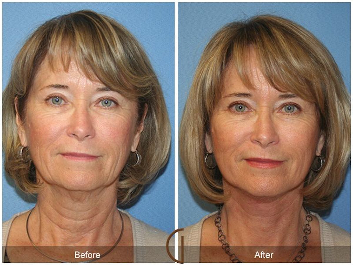 Facelift 60s Before & After Gallery - Patient 104841 - Image 2