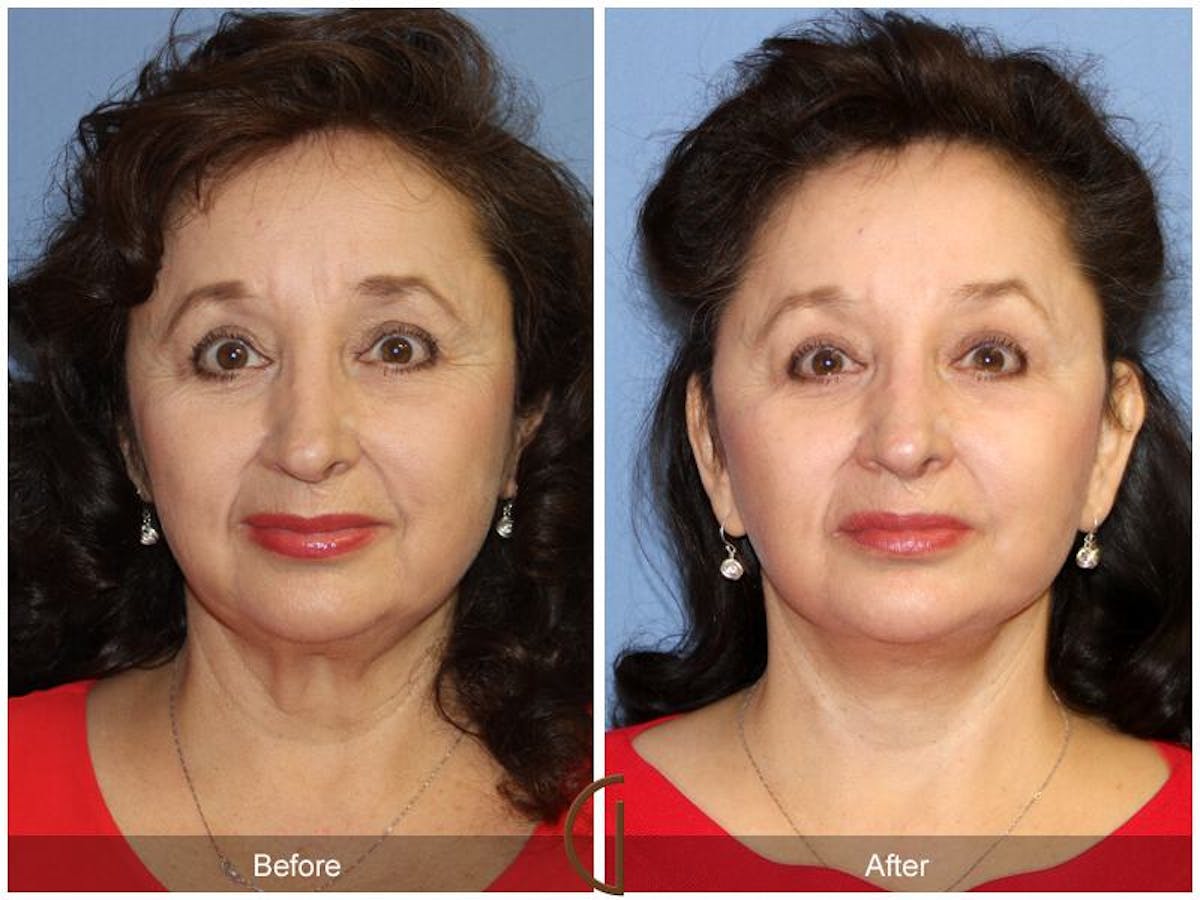 Facelift 60s Before & After Gallery - Patient 213772 - Image 2
