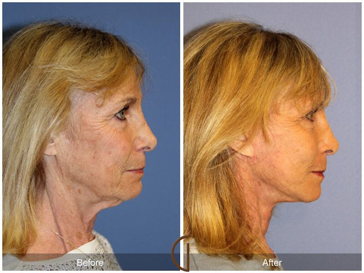 Facelift 60s Before & After Gallery - Patient 380235 - Image 3