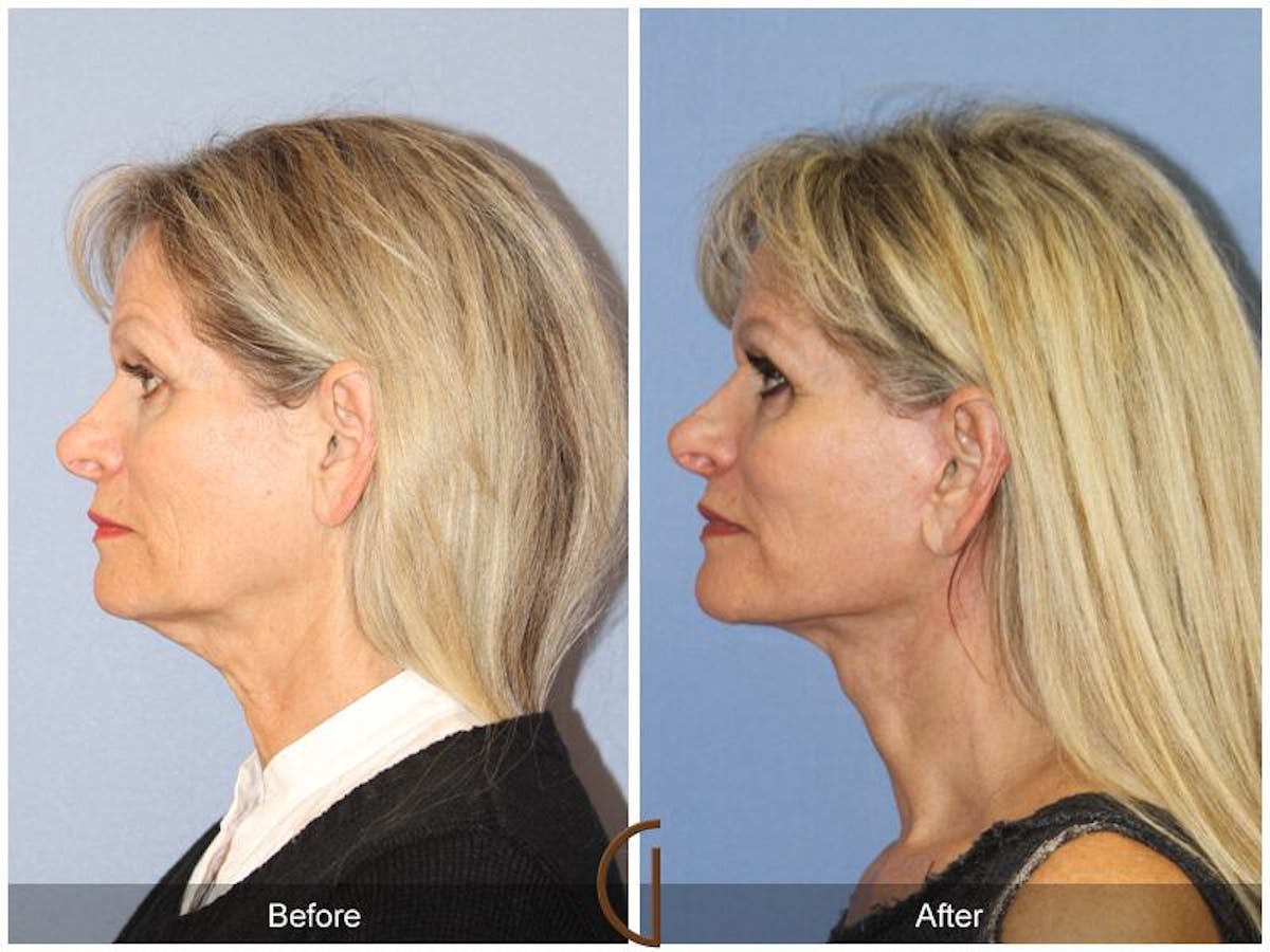Facelift 60s Before & After Gallery - Patient 235547 - Image 1