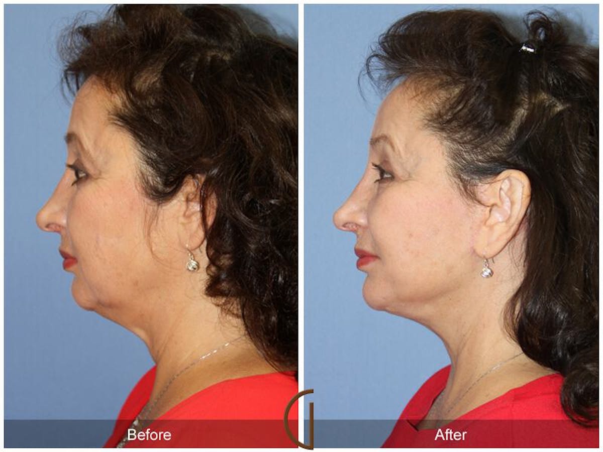 Facelift 60s Before & After Gallery - Patient 213772 - Image 1
