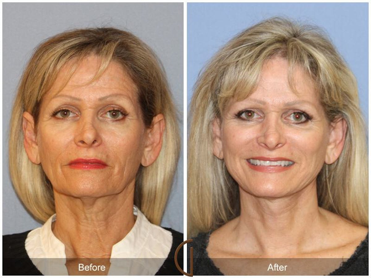 Facelift 60s Before & After Gallery - Patient 235547 - Image 2