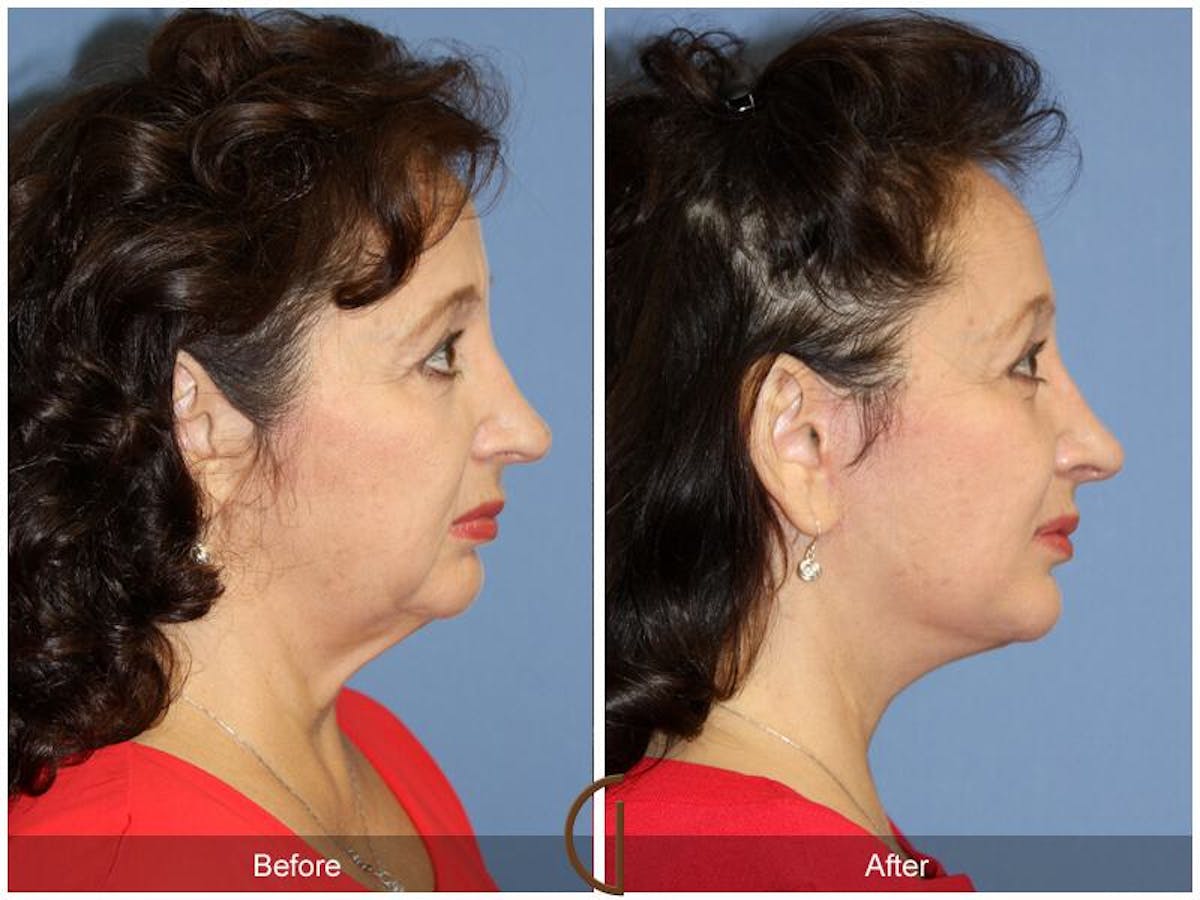 Facelift 60s Before & After Gallery - Patient 213772 - Image 3