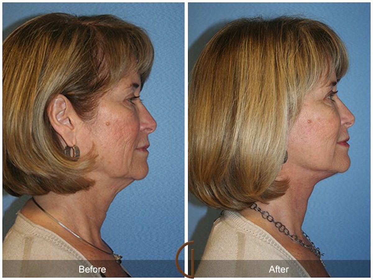 Facelift 60s Before & After Gallery - Patient 104841 - Image 3