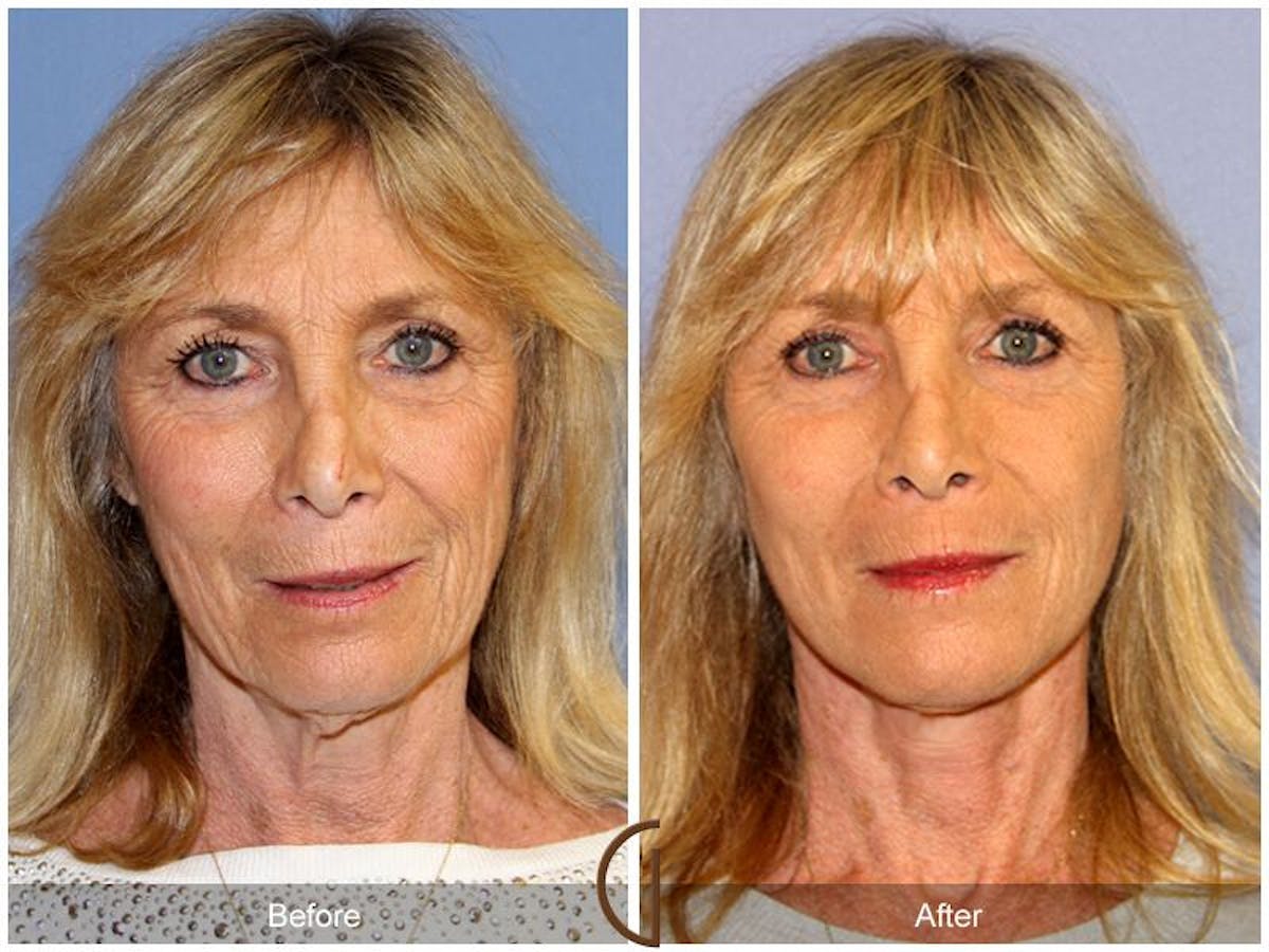 Facelift 60s Before & After Gallery - Patient 380235 - Image 2