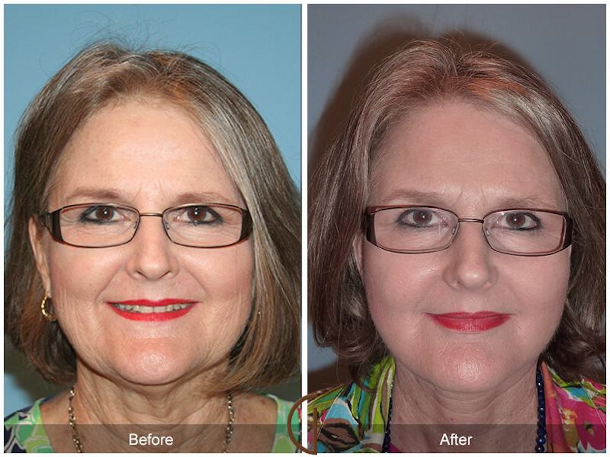Facelift 60s Before & After Gallery - Patient 250379 - Image 2