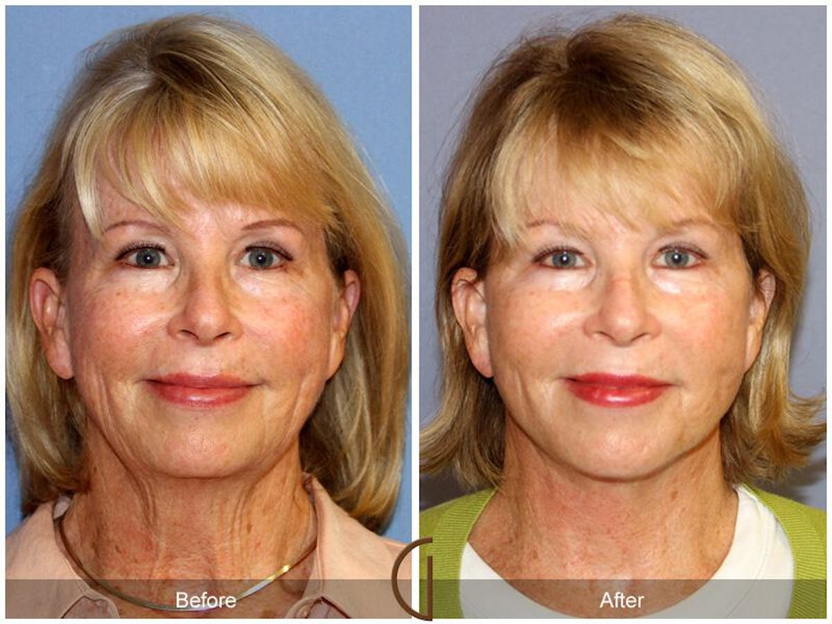 Facelift 60s Before & After Gallery - Patient 222049 - Image 2