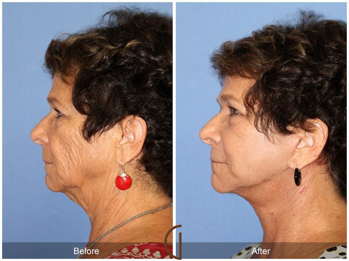 Facelift 60s Before & After Gallery - Patient 379249 - Image 1