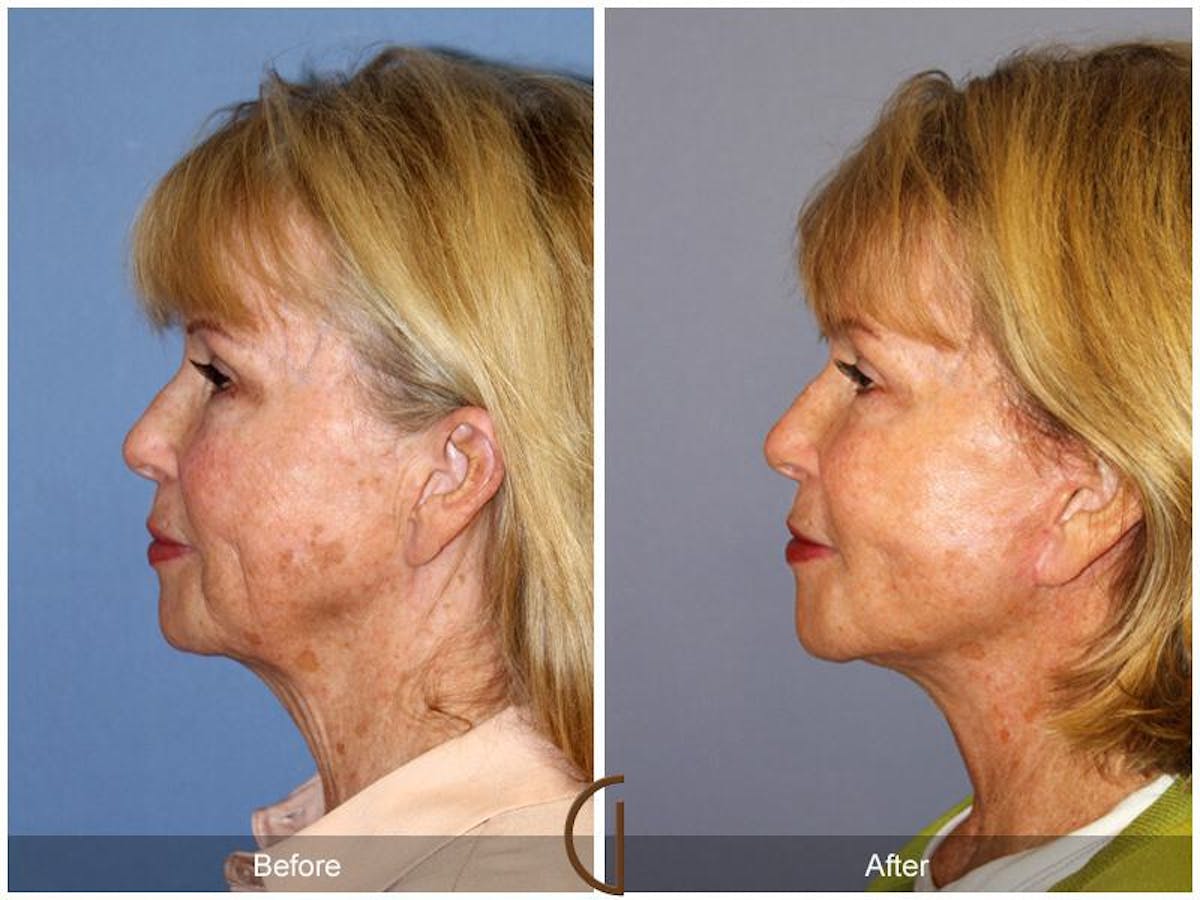 Facelift 60s Before & After Gallery - Patient 222049 - Image 1