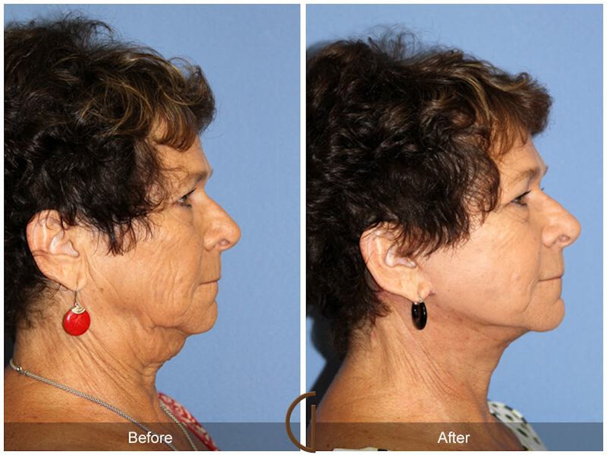 Facelift 60s Before & After Gallery - Patient 379249 - Image 3