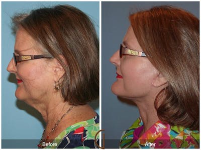 Facelift 60s Before & After Gallery - Patient 250379 - Image 1