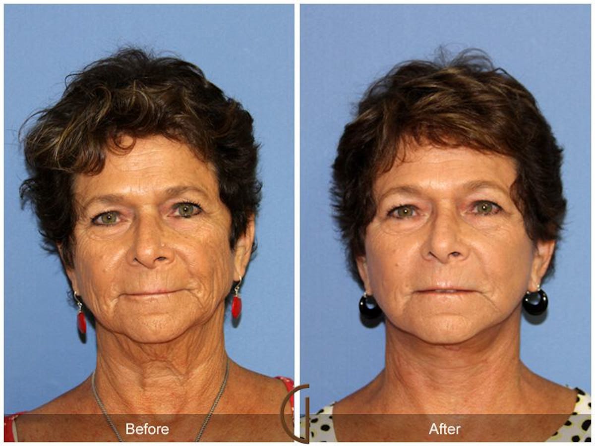 Facelift 60s Before & After Gallery - Patient 379249 - Image 2