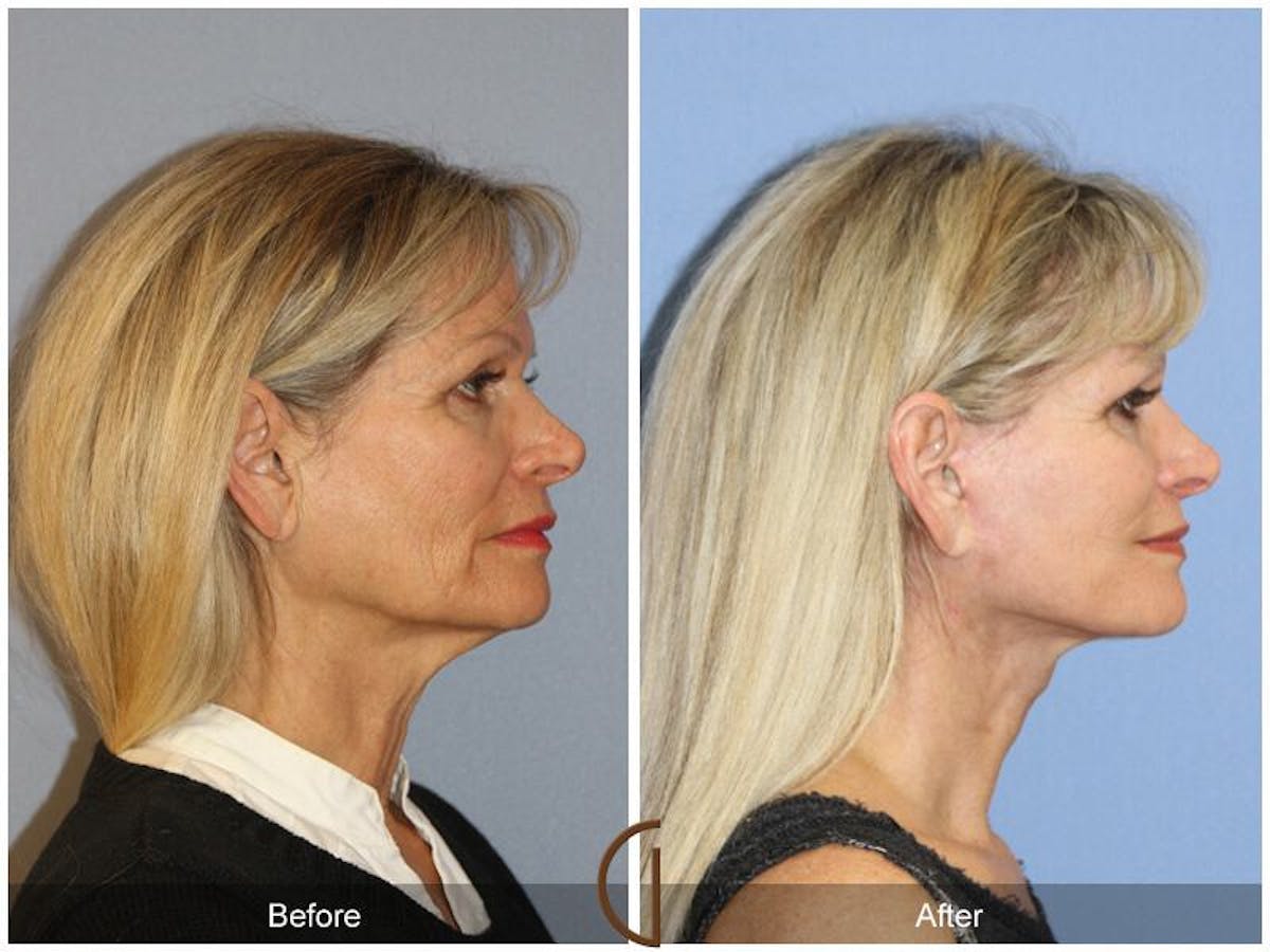 Facelift 60s Before & After Gallery - Patient 235547 - Image 3